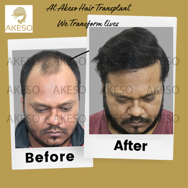 AKESO Hair Transplant gallery photo