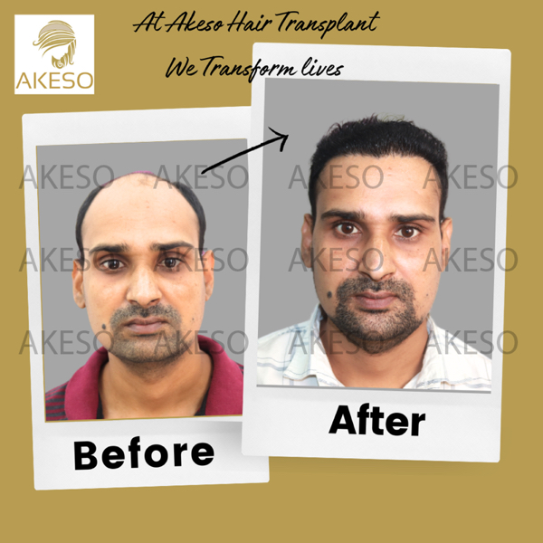 AKESO Hair Transplant gallery photo