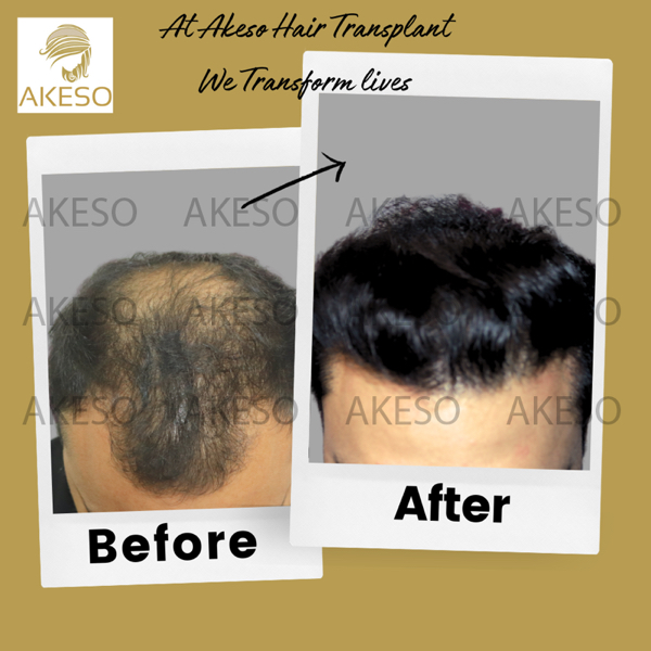 AKESO Hair Transplant gallery photo