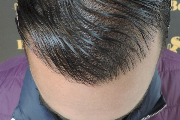 Bold Hair Restoration – Injerto Capilar en Monterrey gallery photo