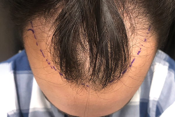Bold Hair Restoration – Injerto Capilar en Monterrey gallery photo