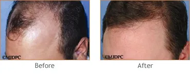 Alabama Hair Transplant at Hedden & Gunn Plastic Surgery gallery photo