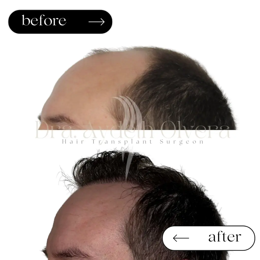 Dr Aydeth Olvera Hair Transplant Tijuana gallery photo