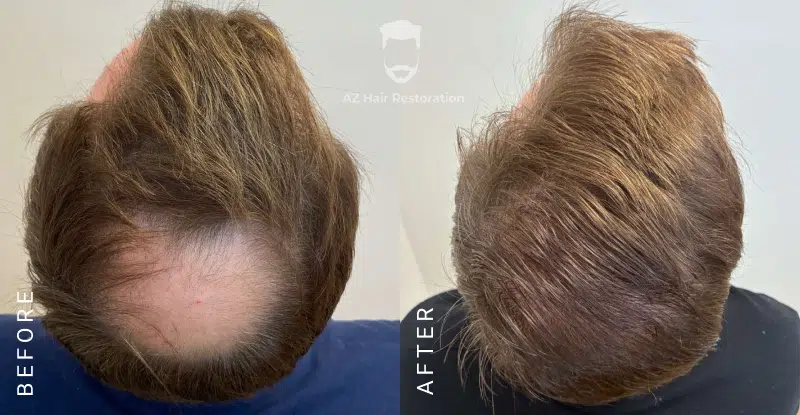 AZ Hair Restoration Clinic Raleigh gallery photo