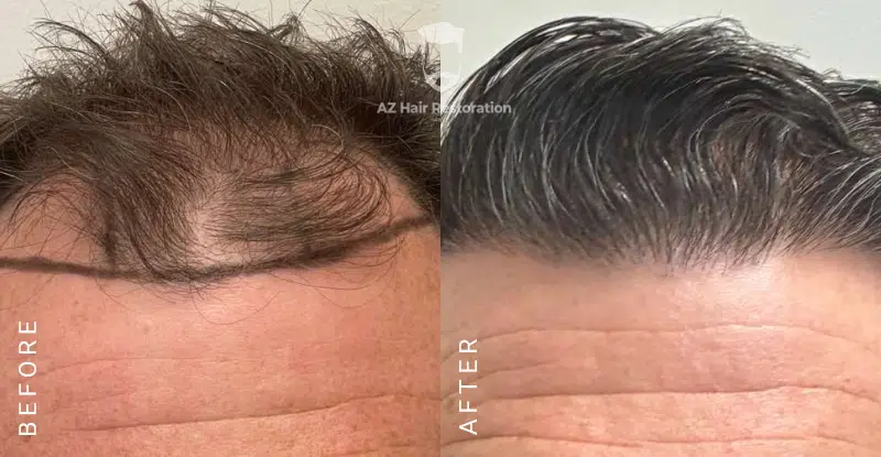 AZ Hair Restoration Clinic Raleigh gallery photo