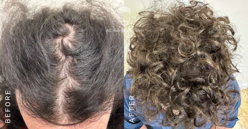 AZ Hair Restoration Clinic Raleigh gallery photo