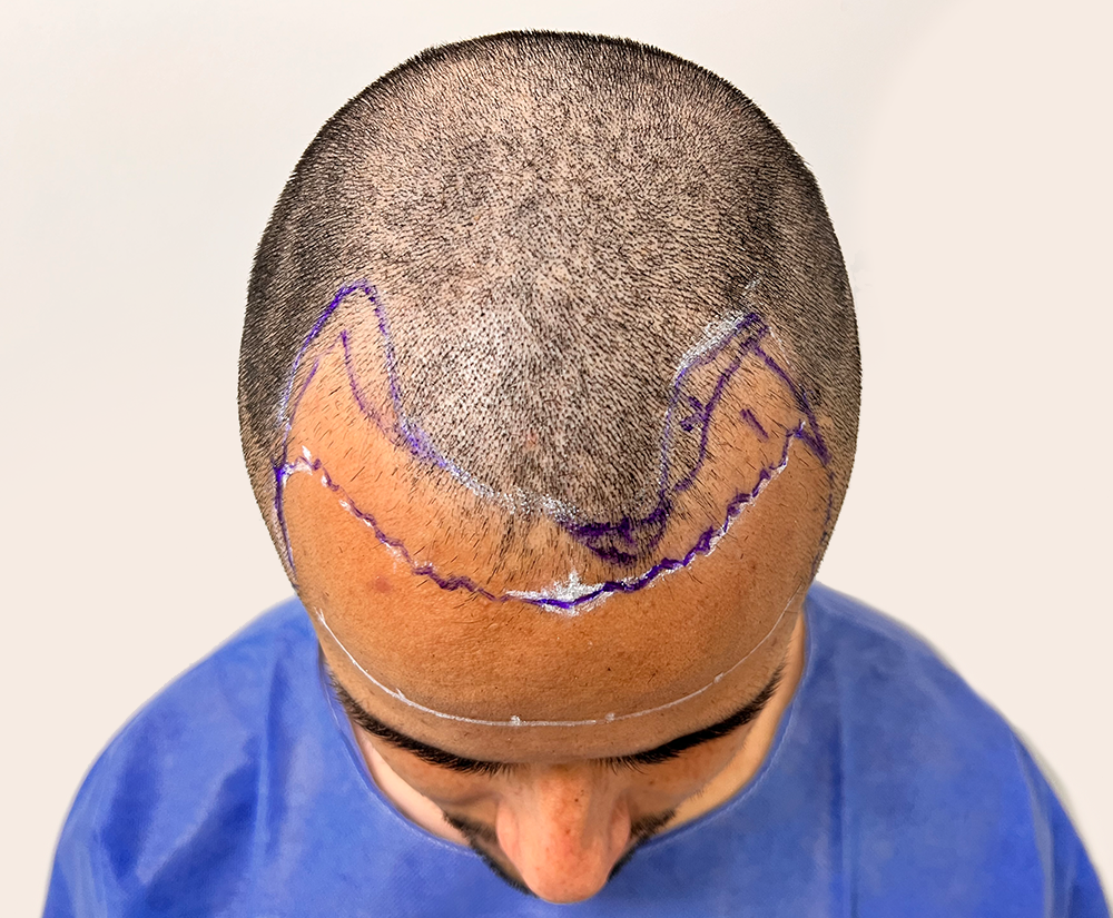 Bianhi Medical Hair Restoration Tijuana gallery photo
