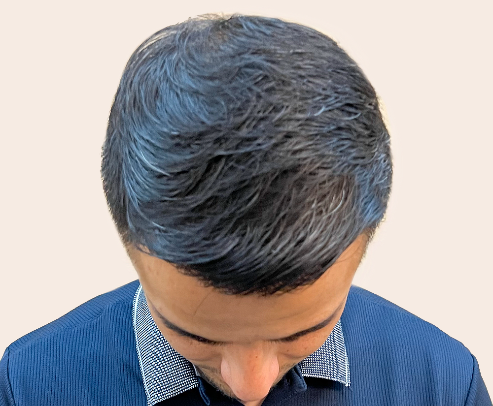 Bianhi Medical Hair Restoration Tijuana gallery photo