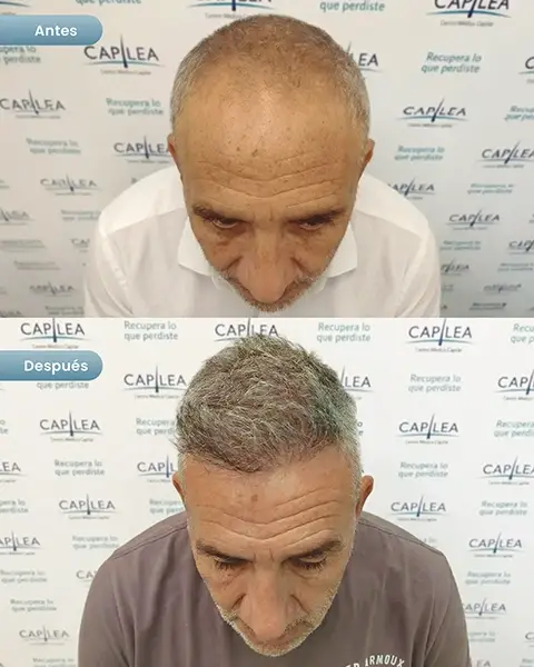 Capilea Belgrano – Clínica de Implante Capilar gallery photo
