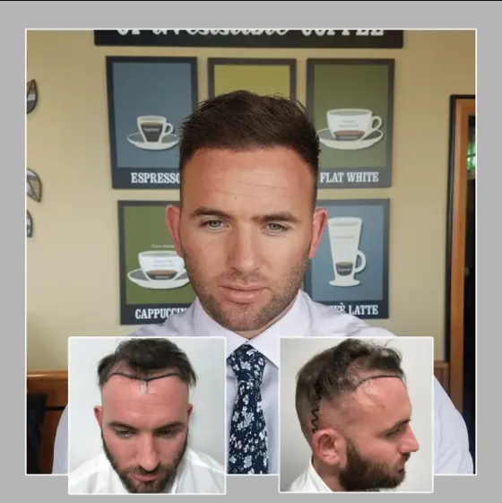 Capital Hair Restoration – Hair Transplant gallery photo