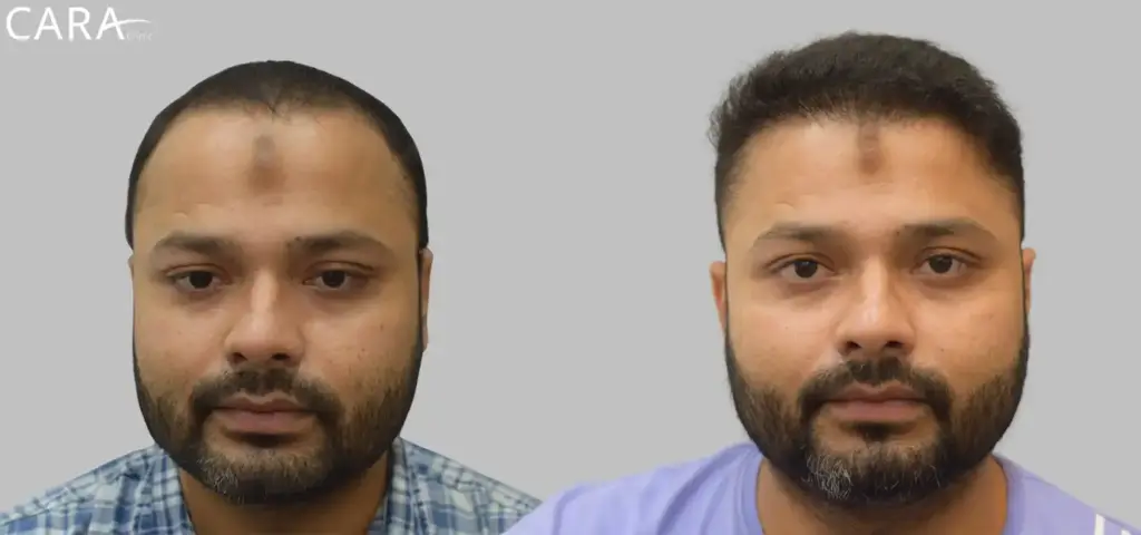 CARA Hair Transplant & Aesthetic Clinic Mumbai gallery photo