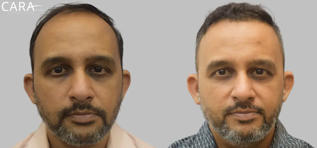 CARA Hair Transplant & Aesthetic Clinic Mumbai gallery photo