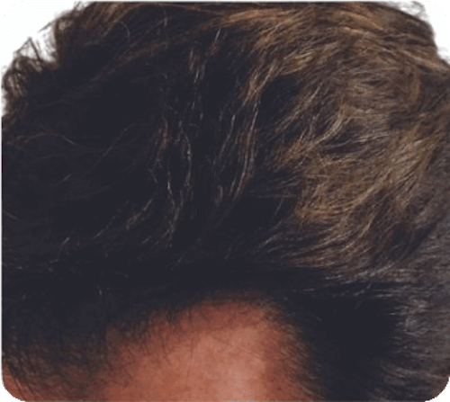 Orlando Robotic Hair Restoration gallery photo