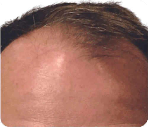 Orlando Robotic Hair Restoration gallery photo