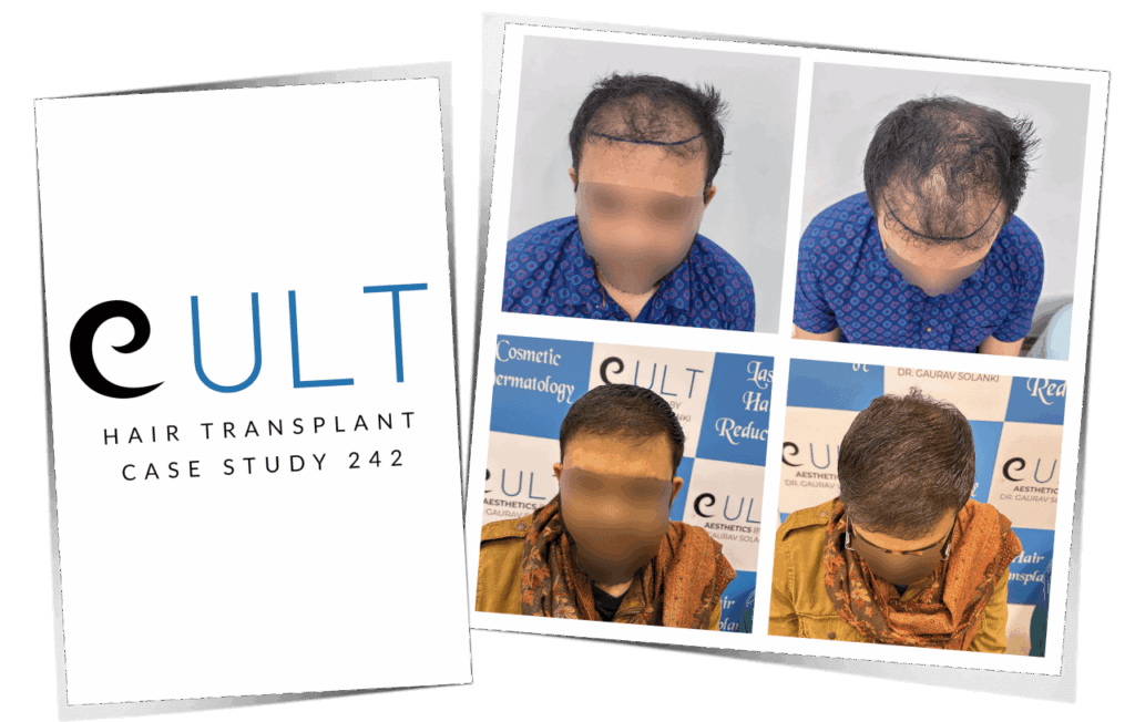 Cult Aesthetics Hair Transplant Clinic In Gurgaon by Dr Gaurav Solanki gallery photo
