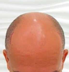 Dra Lisette Pappaterra. CAPMED (Hair Transplant and Aesthetic Medicine). gallery photo