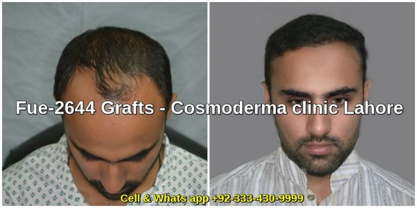 Hair transplant clinic Lahore Dr. Ahmad CH gallery photo