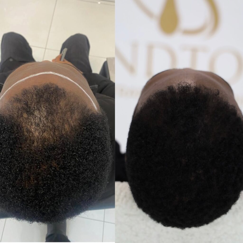 Sandton Hair Transplant Clinic gallery photo