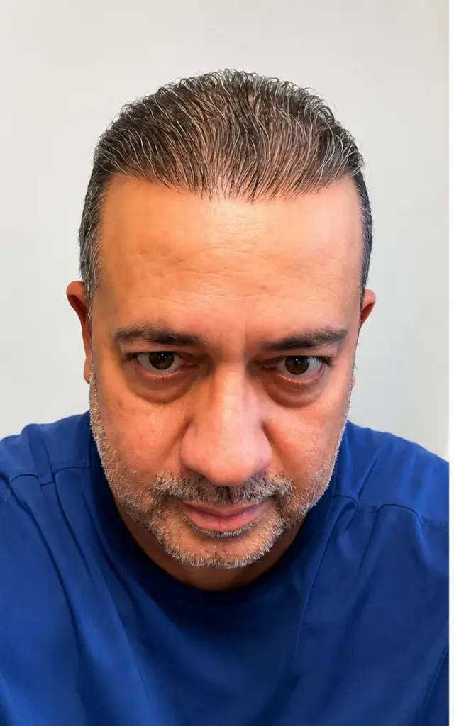 Alpha Hair Restoration gallery photo