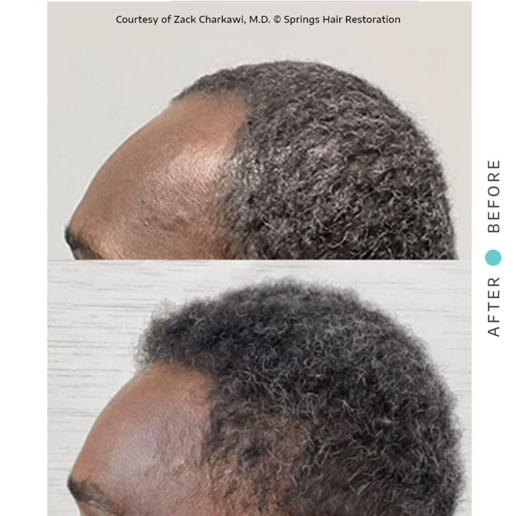Springs Hair Restoration gallery photo