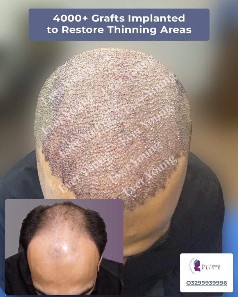 Ever Young Hair Restoration Clinic – Dr. Wajeeha gallery photo