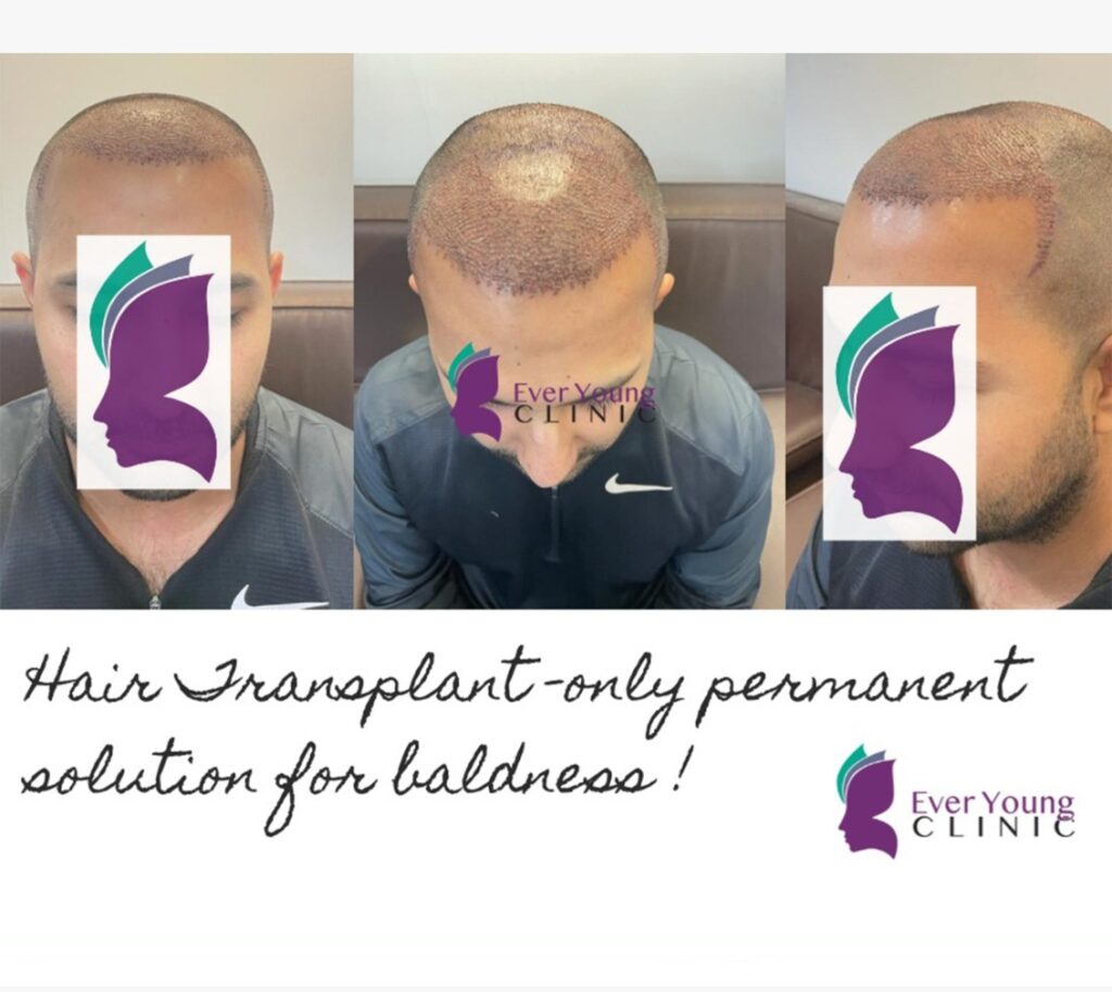 Ever Young Hair Restoration Clinic – Dr. Wajeeha gallery photo