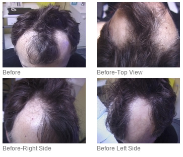 The Woods Technique – Dr Ray Woods FUE Hair Transplant gallery photo