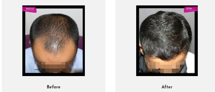 Rejoice Hair Transplant gallery photo