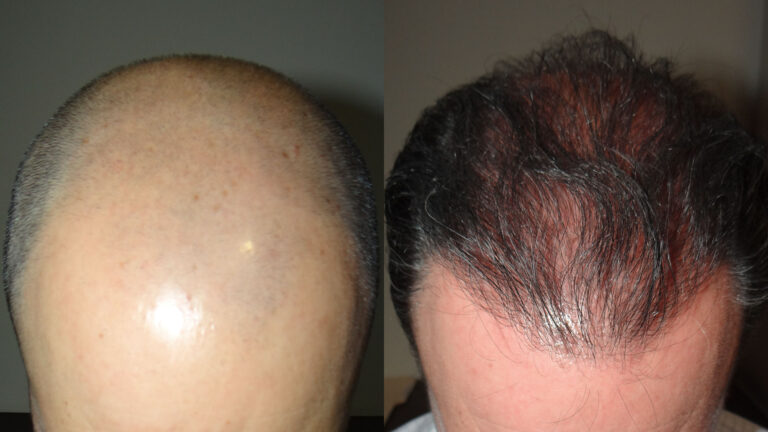 SAVANT Hair Transplant Mexico gallery photo