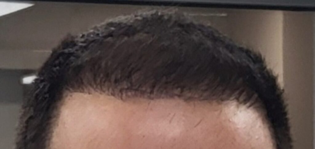 Hair Restoration & Aesthetics of Buffalo gallery photo