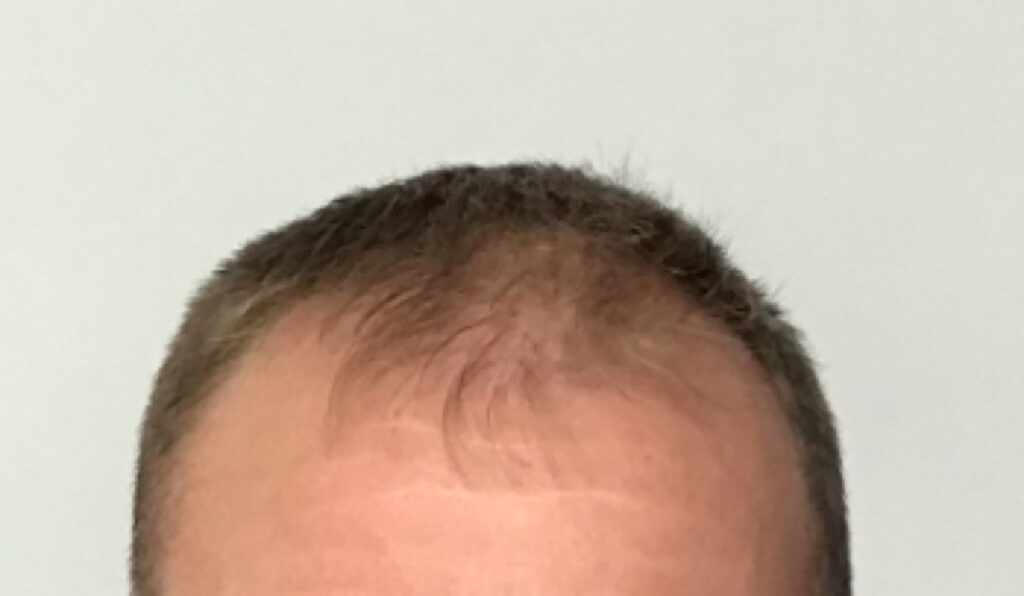 Hair Restoration & Aesthetics of Buffalo gallery photo