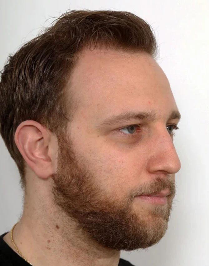 Dr. Benjamin Paul Hair Transplant New York gallery photo