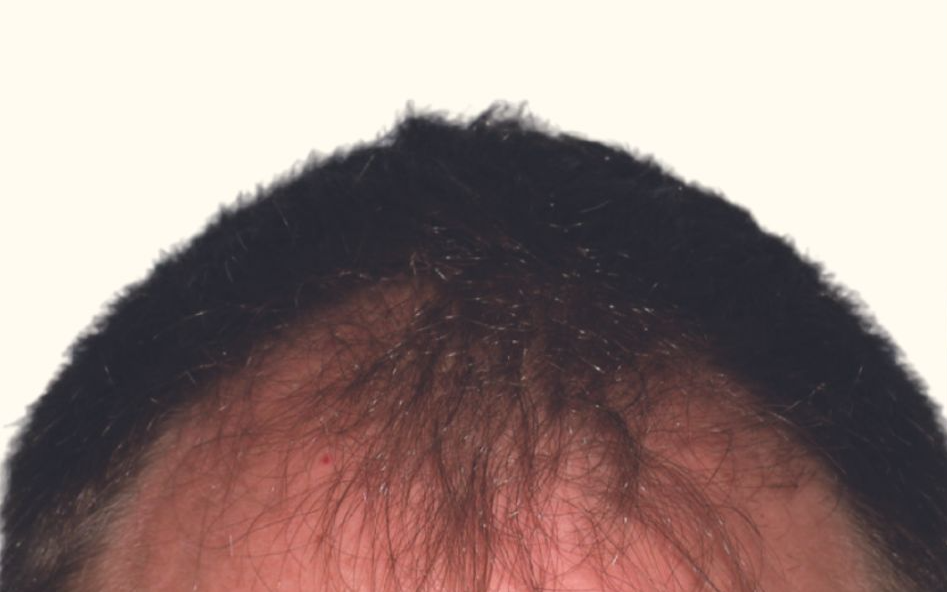Aesthetic Hair Restoration Houston gallery photo