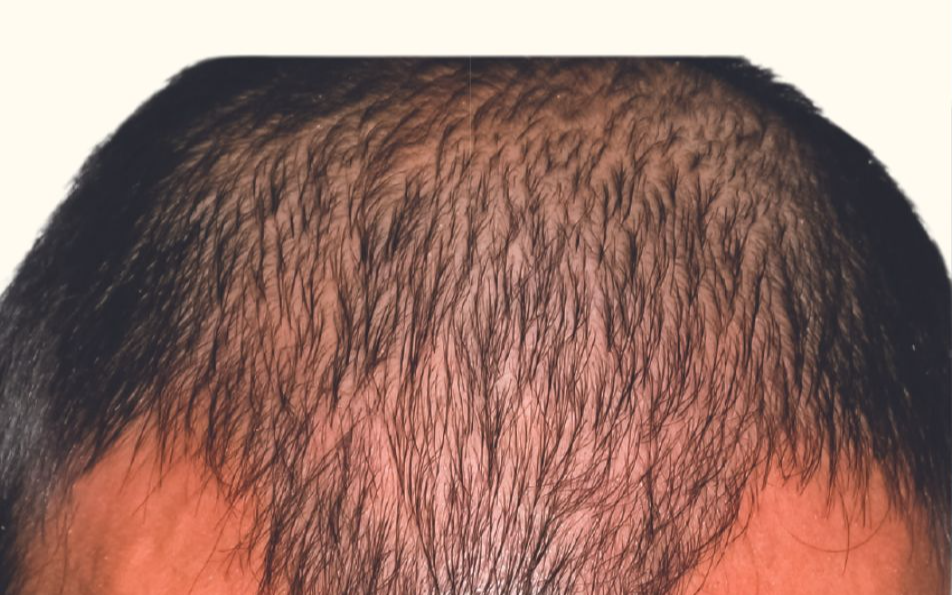 Aesthetic Hair Restoration Houston gallery photo