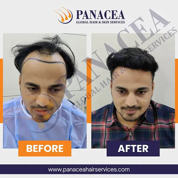 Panacea Global Hair Transplant Delhi gallery photo