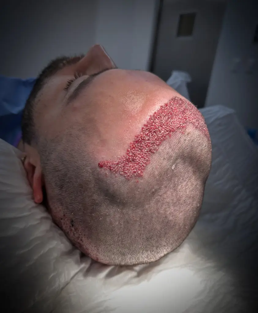 Dr Aydeth Olvera Hair Transplant Tijuana gallery photo