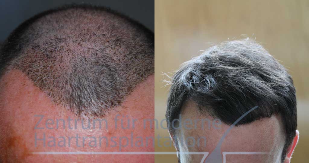 Zentrum für moderne Haartransplantation Berlin – Azar gallery photo