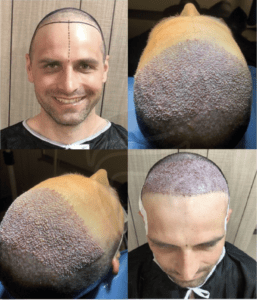 New Hair Clinic Cologne gallery photo