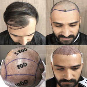 New Hair Clinic Cologne gallery photo
