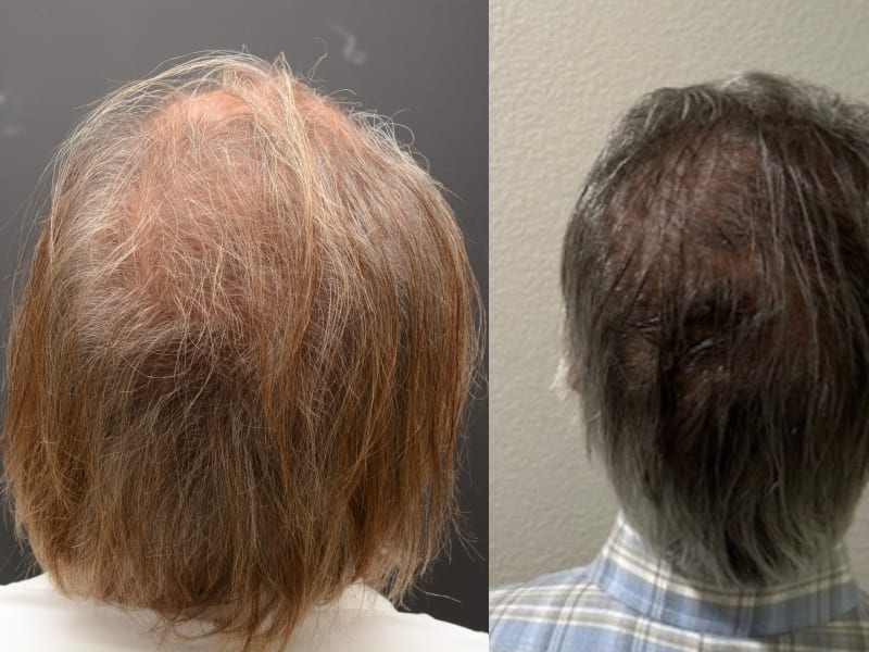Hair Transplant Newport Beach gallery photo