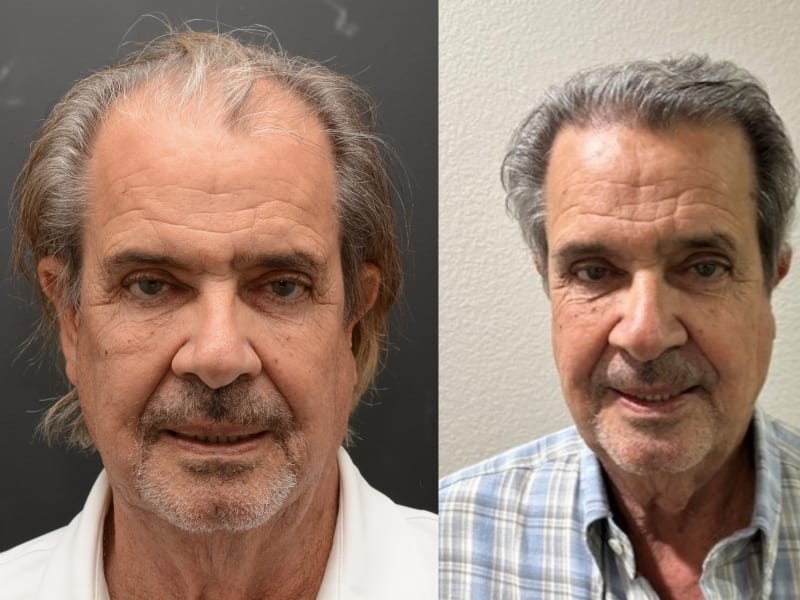 Hair Transplant Newport Beach gallery photo