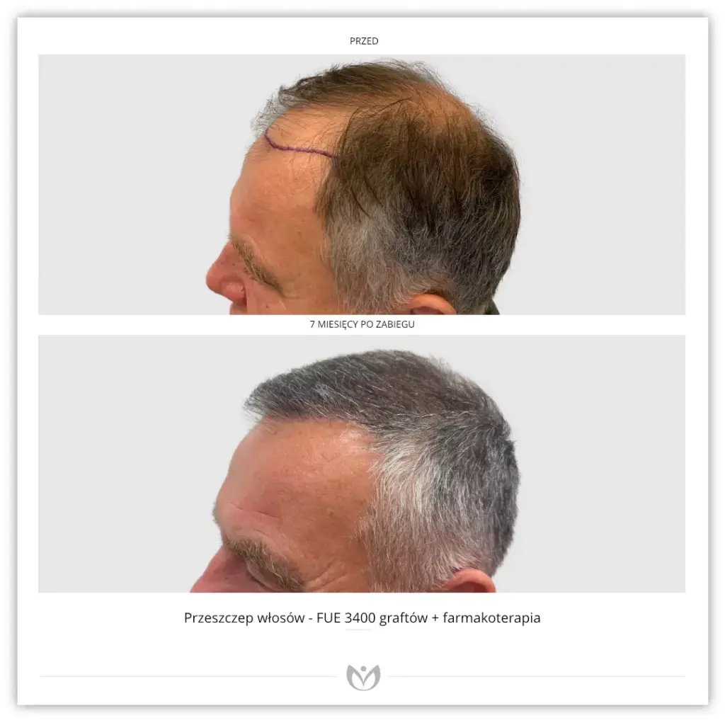 Klinika Elite Hair Transplant Warsaw – Zlota gallery photo