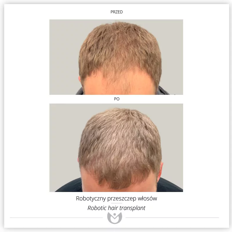 Klinika Elite Hair Transplant Warsaw – Zlota gallery photo