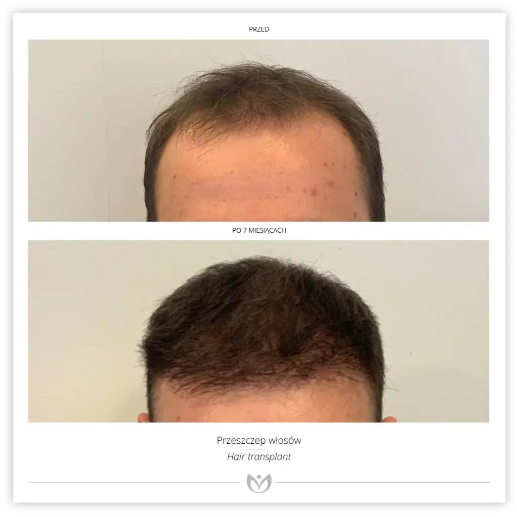 Klinika Elite Hair Transplant Warsaw – Zlota gallery photo