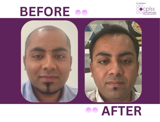 CPLSS – Dr. Viral Desai Hair Transplant Mumbai gallery photo