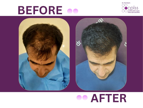 CPLSS – Dr. Viral Desai Hair Transplant Mumbai gallery photo