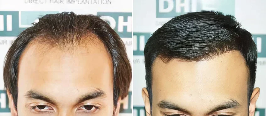 DHI Hair Transplant Clinic Thailand – Phra Khanong gallery photo