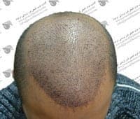 Iranian Hair Transplantation and Laser Clinic Isfahan gallery photo