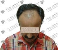 Iranian Hair Transplantation and Laser Clinic Isfahan gallery photo
