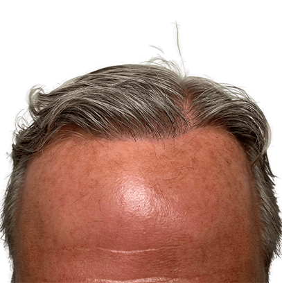 Dr Shintre Hair Restoration Boca Raton gallery photo